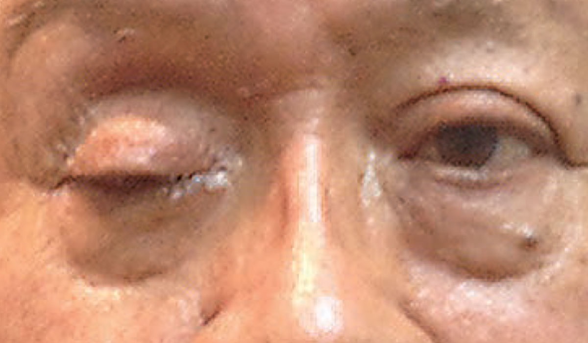 How is Ptosis Classified?