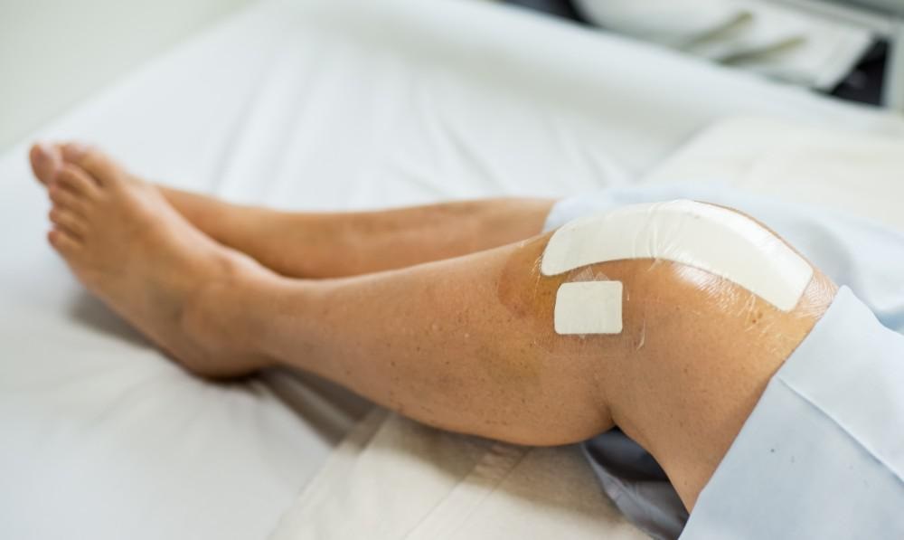 What To Know Knee Arthroplasty Surgery