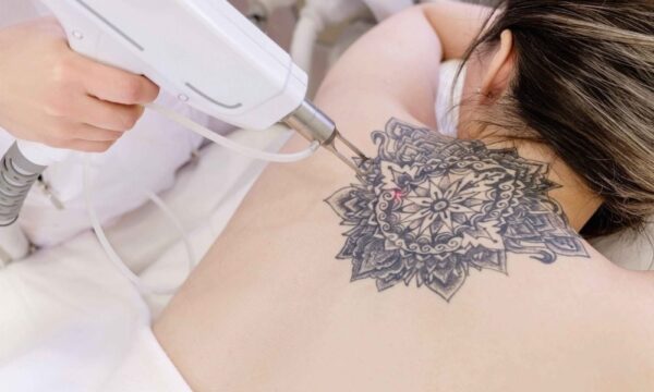 Remove Unwanted Ink with Modern Tattoo Removal Techniques