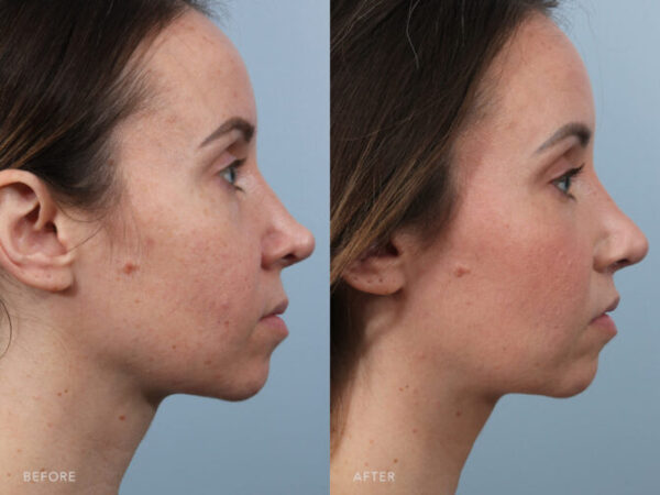 Double Chin Liposuction: A Comprehensive Guide to Your NYC Options